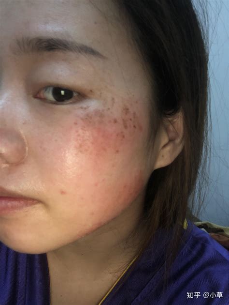 五天祛斑可靠吗