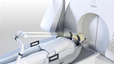 伽玛刀手术安全吗