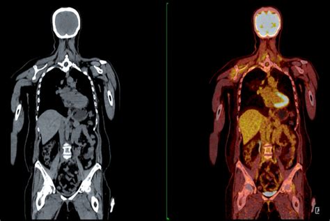 全身热ct靠谱吗