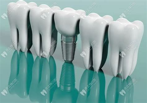 种植牙私立医院可靠吗