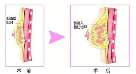 自身丰胸安全吗