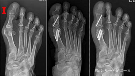 超微创拇外翻手术安全吗