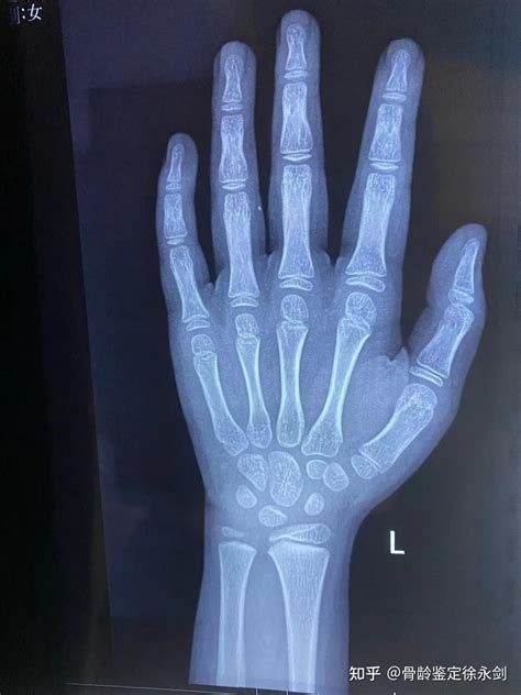 骨龄到底可信不